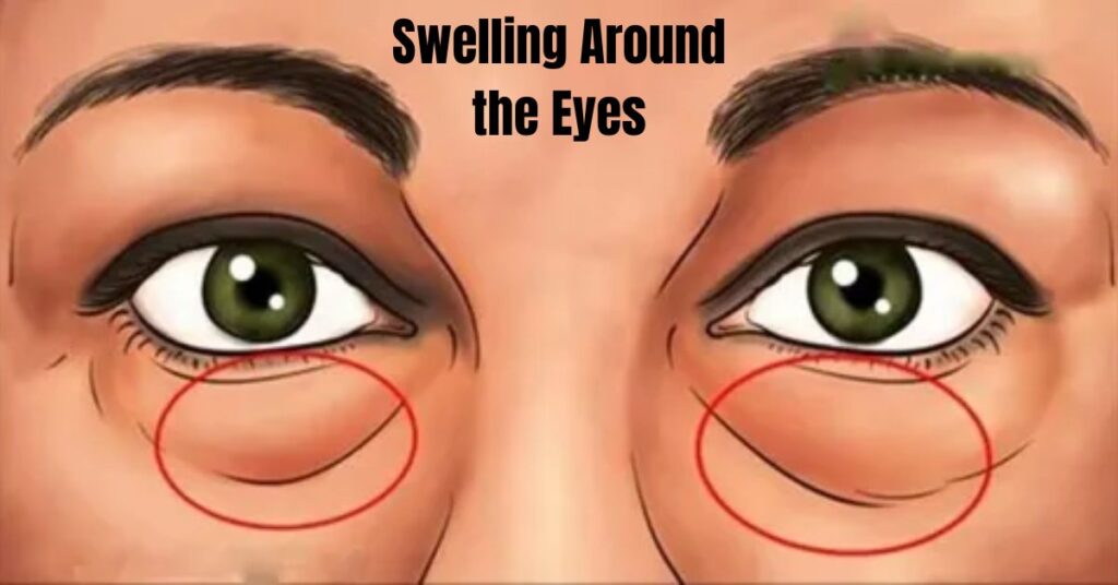 Swelling Around the Eyes