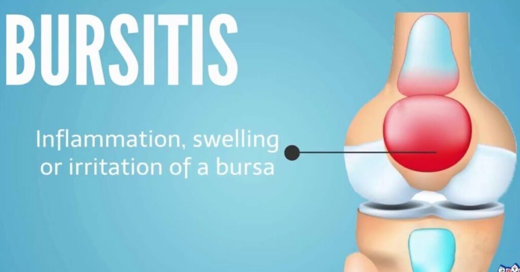 Bursitis: Inflammation of the Bursa