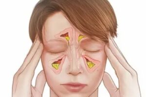 Sinusitis Symptoms: A Comprehensive Guide