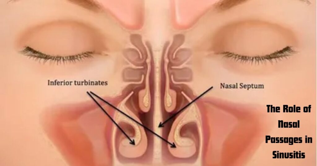 The Role of Nasal Passages in Sinusitis